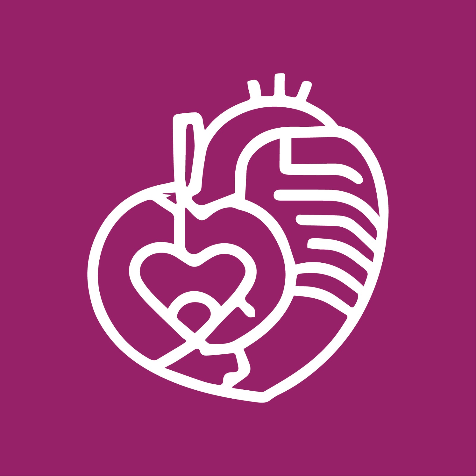 Arrhythmogenic Right Ventricular Dysplasia